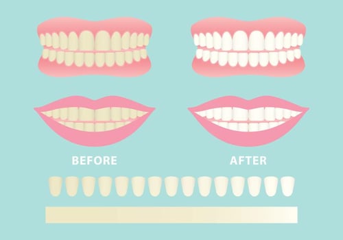 Clean And Dirty Teeth Vectors