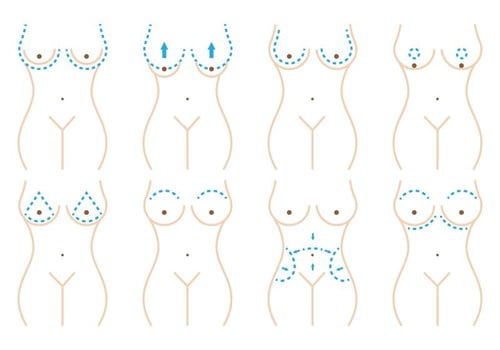 Breast Surgery vector