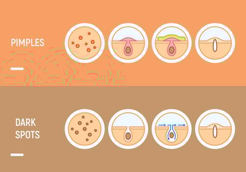 Pimple Skin Problems vector