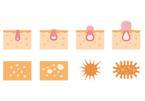 Set Of Pimple Icons vector