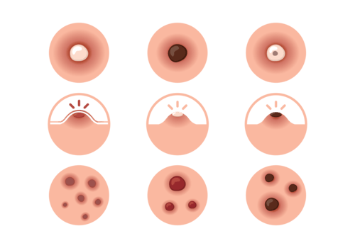 Pimple Icons Vector