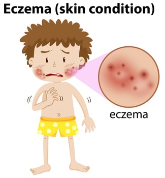 A Young Boy Having Eczema vector
