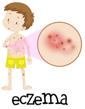 Human Medical Education of Eczema vector