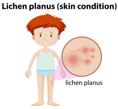 A Young Man Having Lichen Planus vector