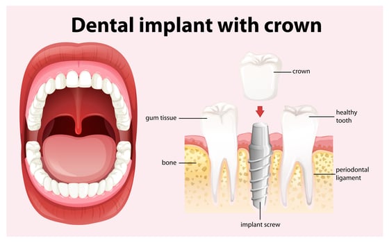 Dental Implant with Crown Vector