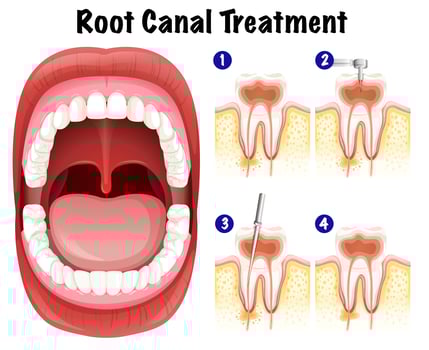 Dental Vector of Root Canal Treatment