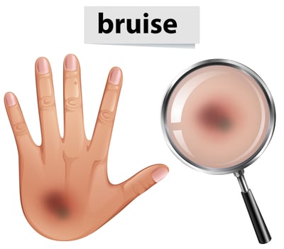 A Human Hand with Bruise vector