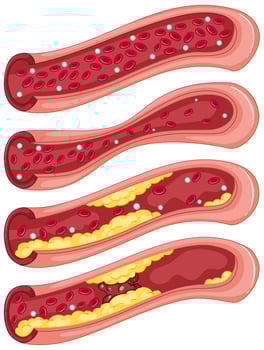 Diagram showing blood clot in human veins vector