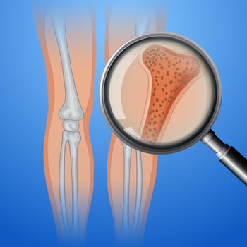 Human bone with osteoporosis vector
