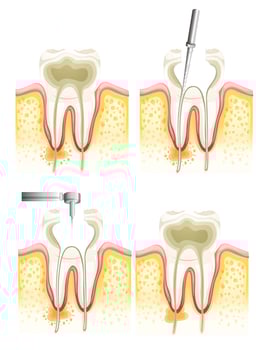 Root canal process vector