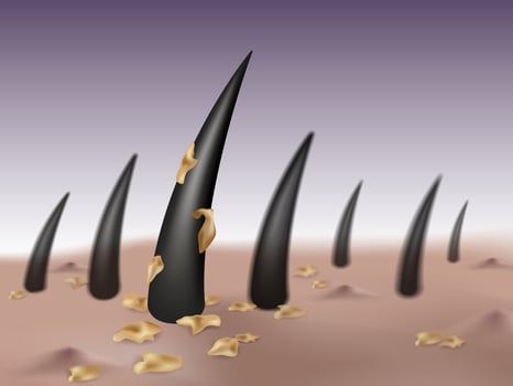 Dandruff and scalp disease concept  vector