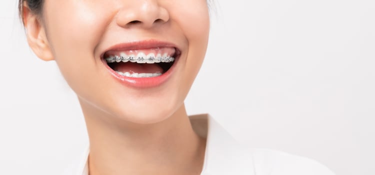 Close-up of person wearing braces  photo