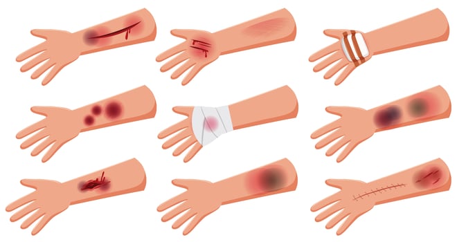 Group of lesion on arm skin injury accident  cartoon style vector