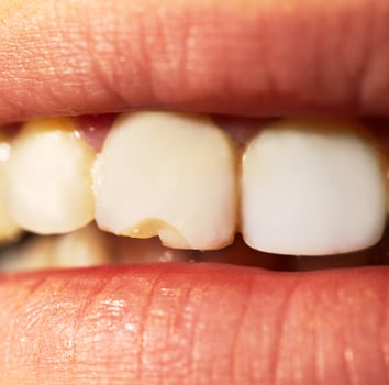 Close-up of a chipped tooth photo