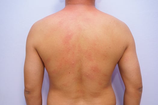 Male adult with acute onset food allergy with hives on entire body photo