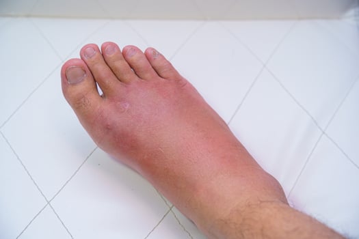 Close-up of an old man's wounded right foot photo