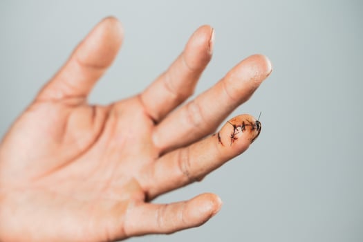 Close up of man hand with sutured wound on finger. Injured, Helth and medical Concept. photo