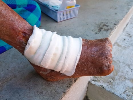 left foot of leprosy woman with gauze photo