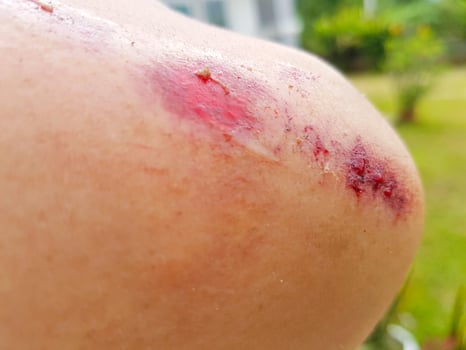 close-up fresh red bloody wound on the elbow photo