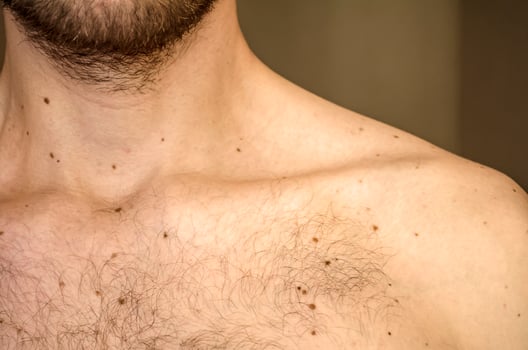 The clavicle of a young man. Moles photo