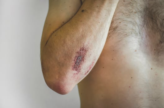 The young man was injured in sports. photo