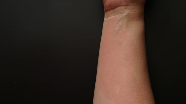 Female hand covered with red spots, close-up. Allergic reaction photo