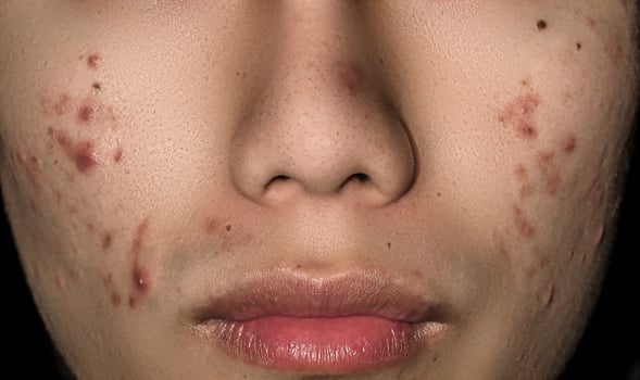 Close up of acne on the skin, Acne on the face caused by Hormone. photo