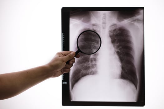 Doctor zoom x-ray ,doctor checking chest x-ray film at ward hospita photo