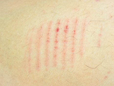 Close-up scar scratch on the human body photo