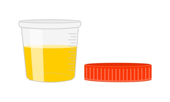 Urinalysis. Urine sample, full open plastic container with removed cover. Laboratory examination and diagnostics concept vector