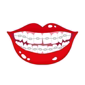 Vector cartoon smiling mouth with stages of crooked teeth alignment using orthodontic metal braces.