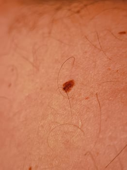 mole of the skin of an adult man photo