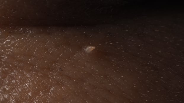 Wart on face. Macro shot of wart near eye. Papilloma on skin. photo