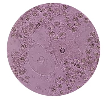 Microscopic image show plenty Pus cells with few Epithelial cells. Urinary tract infection. Pyuria.40X photo
