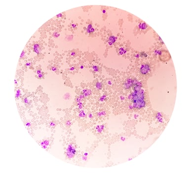 Chronic myelocytic leukemia with chronic phase. Hematology. CML photo