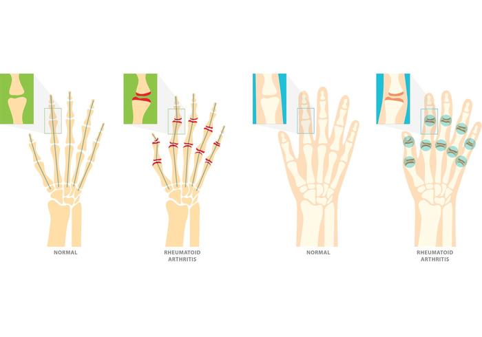 Rheumatoid Arthritis Vector Symbols Rheumatoid Arthritis Vector Symbols