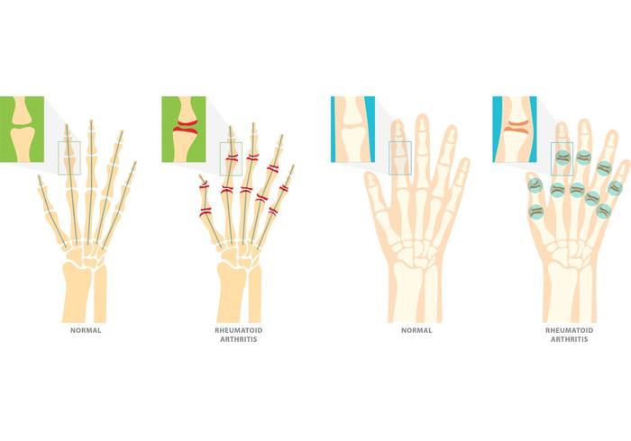 Síntomas del vector de la artritis reumatoide