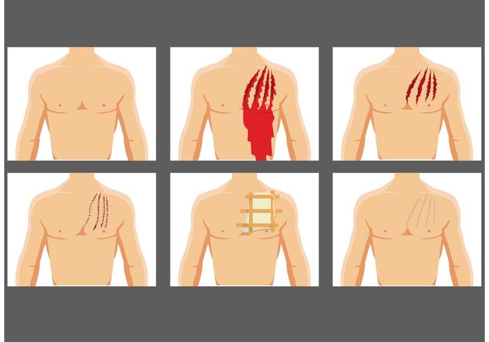 Ripping Wound Vectors