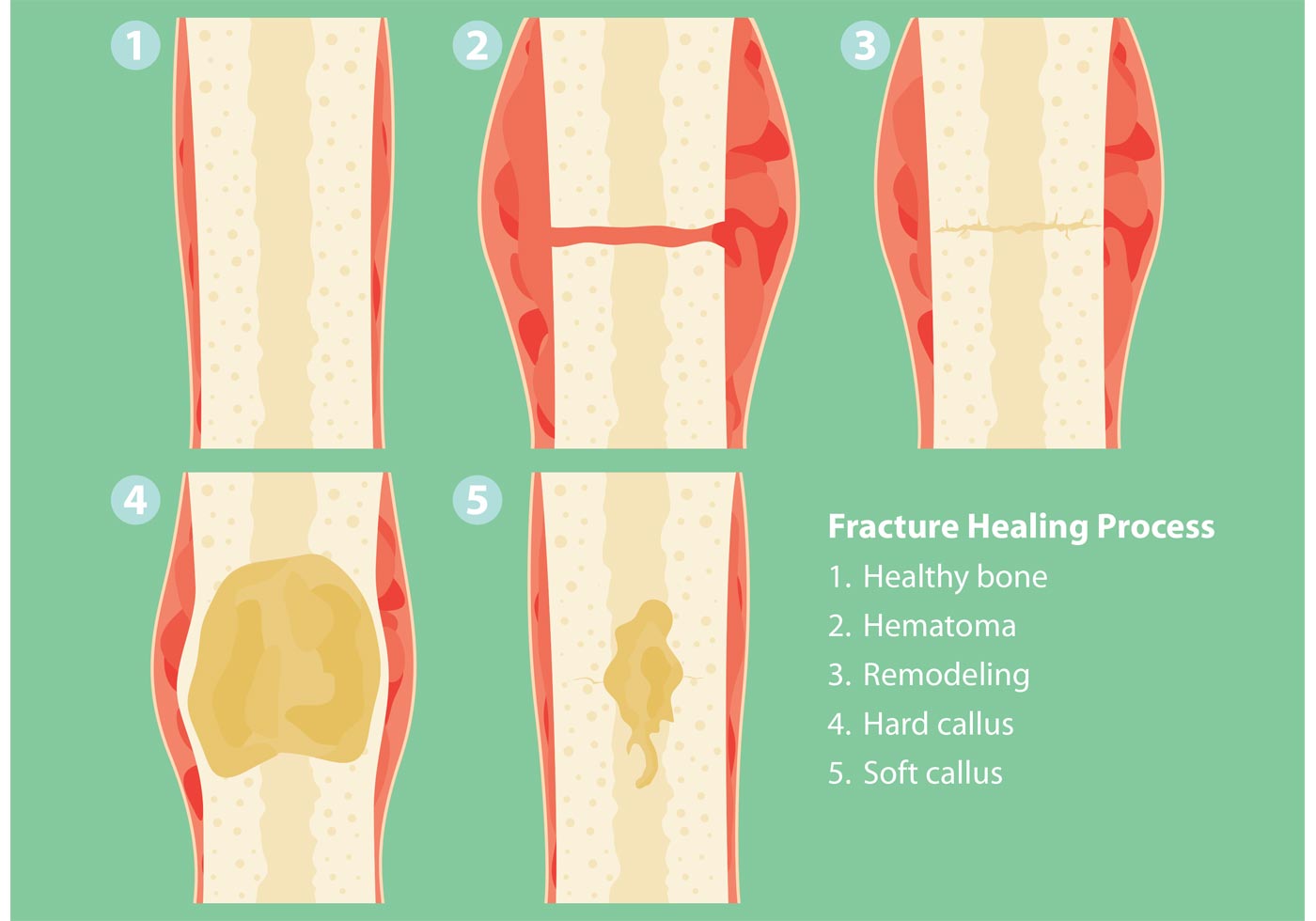 Fractures and Healing Process Vectors - Download Free Vector Art, Stock