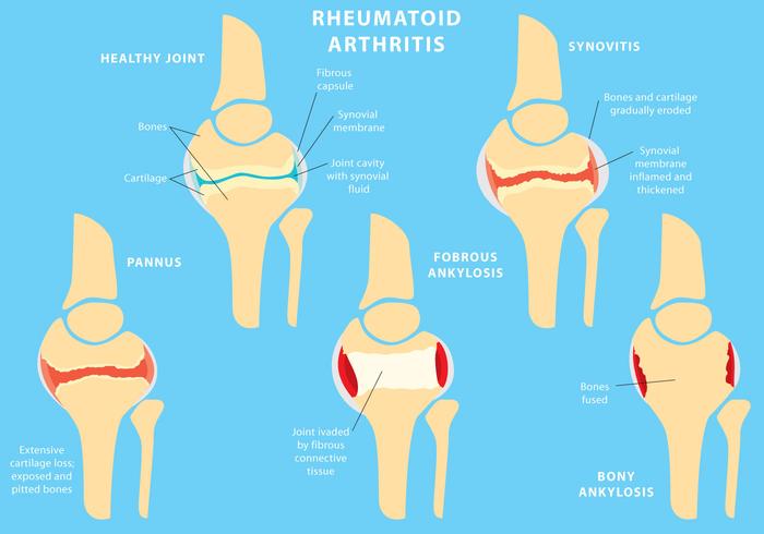 Joint Rheumatoid Arthritis 94146 Vector Art at Vecteezy