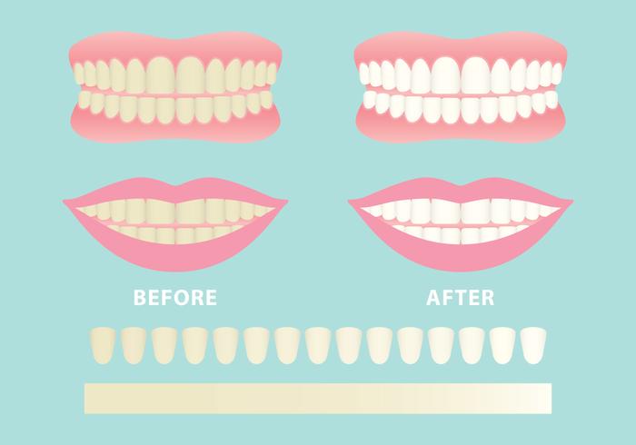 Clean And Dirty Teeth Vectors