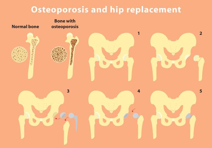 Osteoporosis y reemplazo de cadera Vector Info