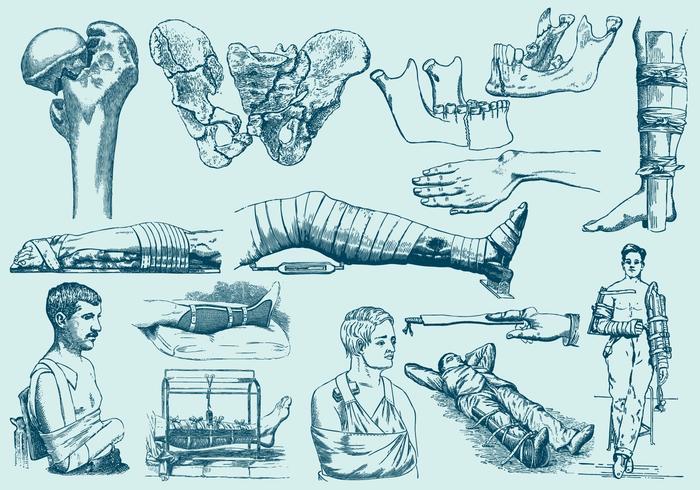 Blue Fracture Treatment Illustrations Blue Fracture Treatment Illustrations