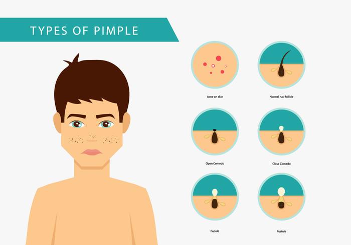 Pimple on Man Vector