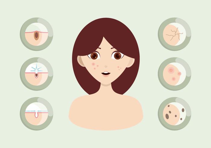 Ilustración de Pimple vector