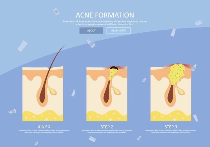 Free Pimple Formation Illustration vector