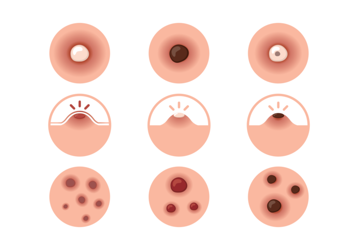 Pimple Icons Vector