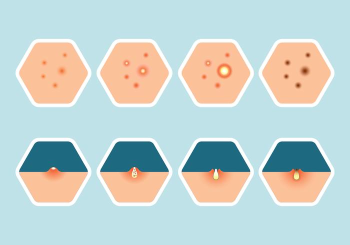 Conjunto de iconos de Pimple vector