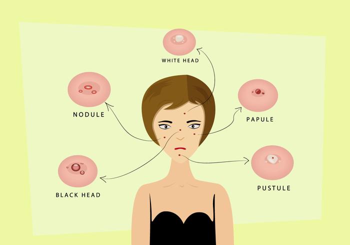 Pimple en los tipos de la piel de la mujer vector