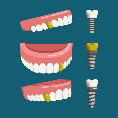 False Teeth With Screw Vector Illustration